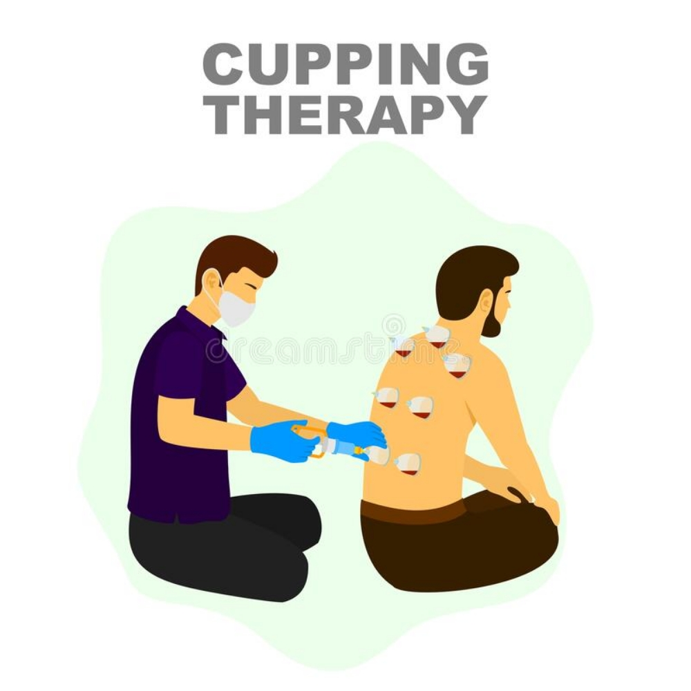 Cupping Therapy  - 2