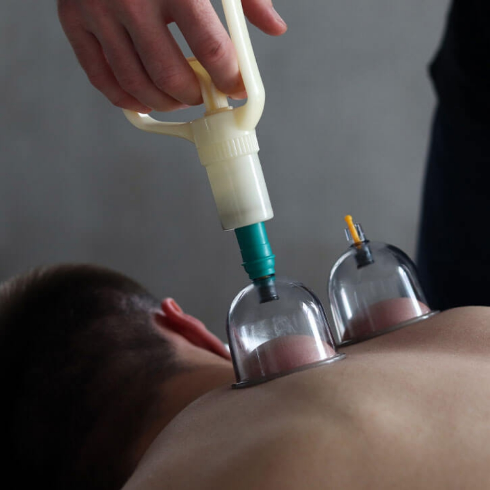 Cupping Therapy  - 3