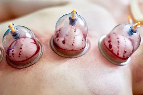 cupping therapy hijama - 1