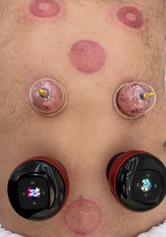 cupping therapy hijama - 3