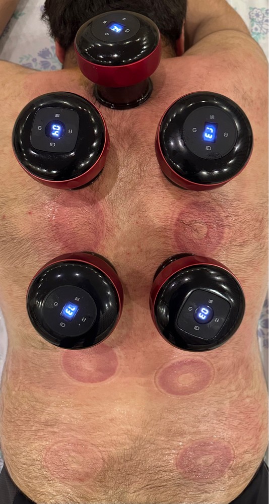 cupping therapy hijama - 4