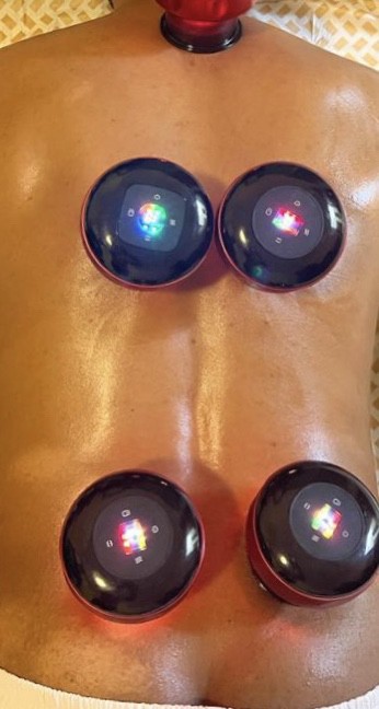 cupping therapy hijama - 2