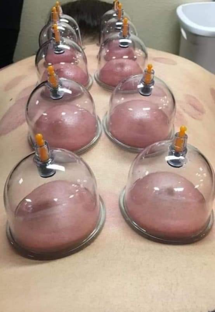 حجامة طبية نبوية على سنة رسول لله - 6
