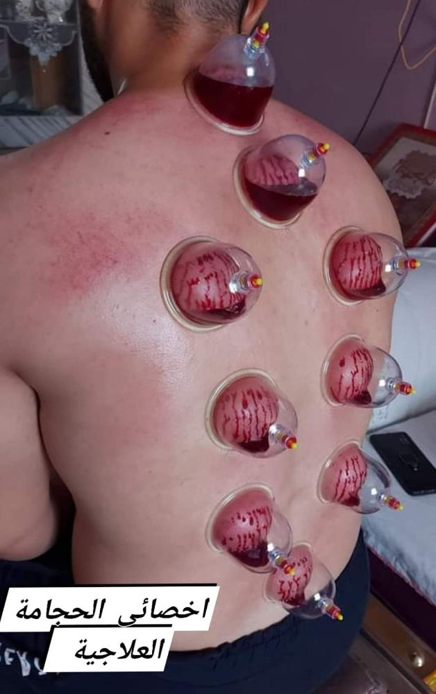 حجامة طبية نبوية على سنة رسول لله - 2