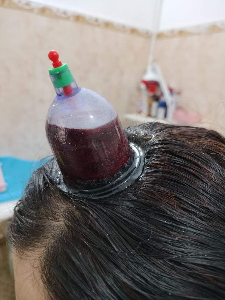 حجامة طبية نبوية على سنة رسول لله - 11