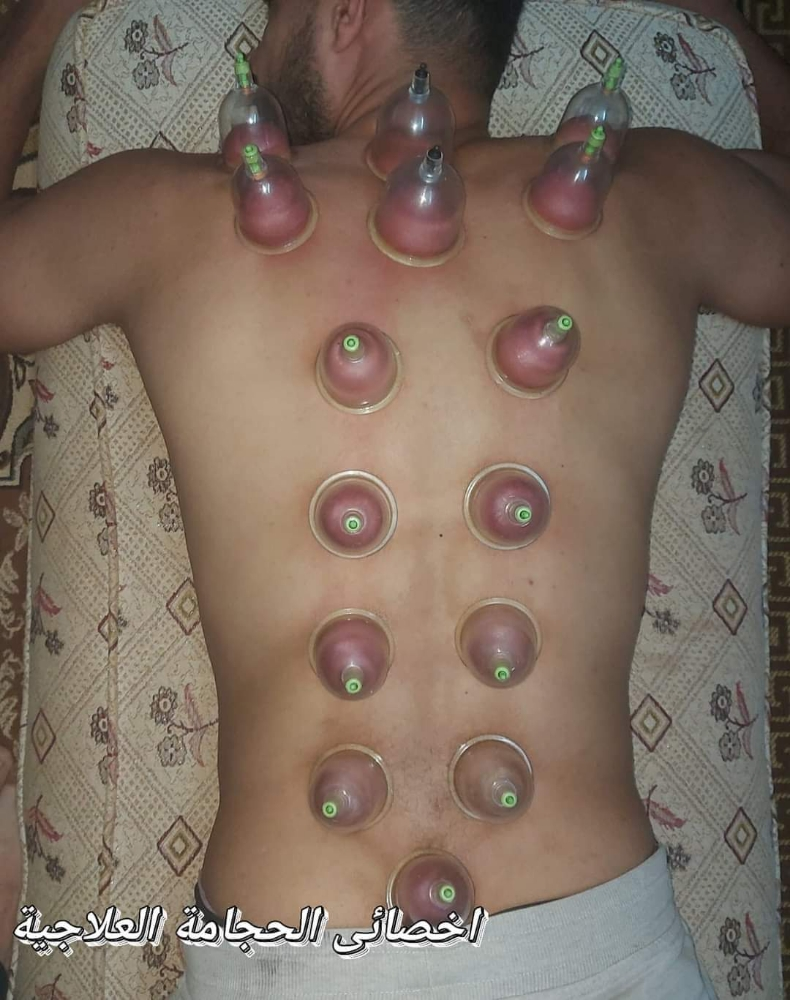 حجامة طبية نبوية على سنة رسول لله - 4