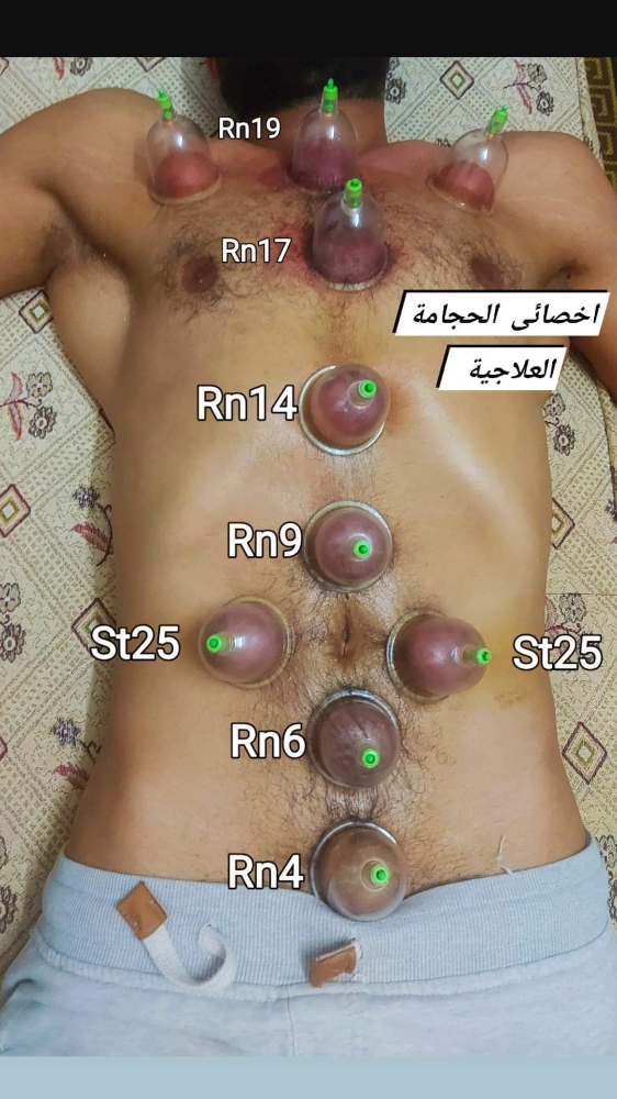 حجامة طبية نبوية على سنة رسول لله - 3