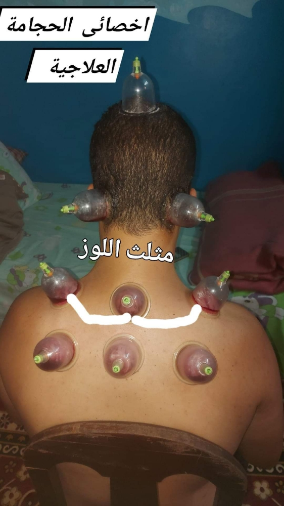 حجامة طبية نبوية على سنة رسول لله - 9