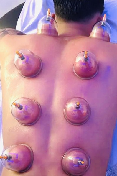 cupping therapy hijama - 6