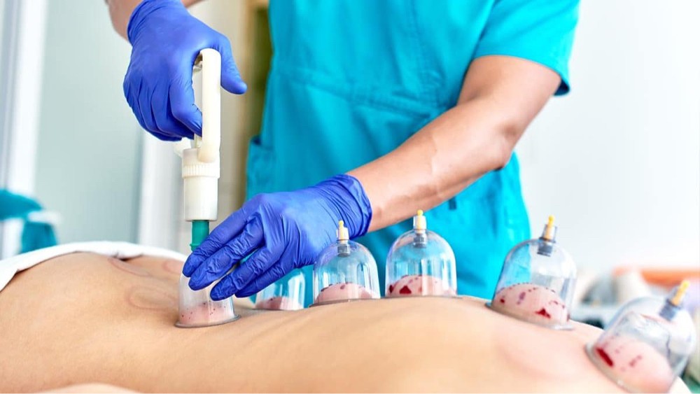 cupping therapy hijama - 8