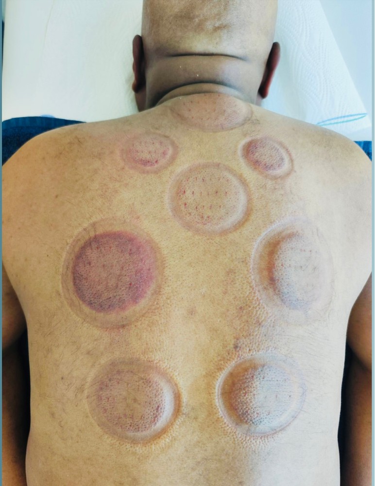 cupping therapy hijama - 9