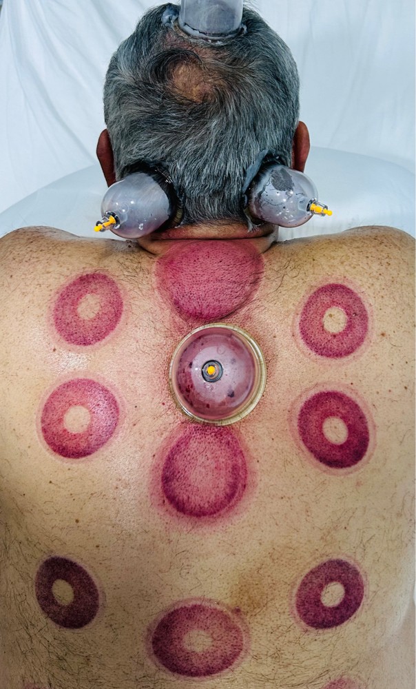 cupping therapy hijama - 7