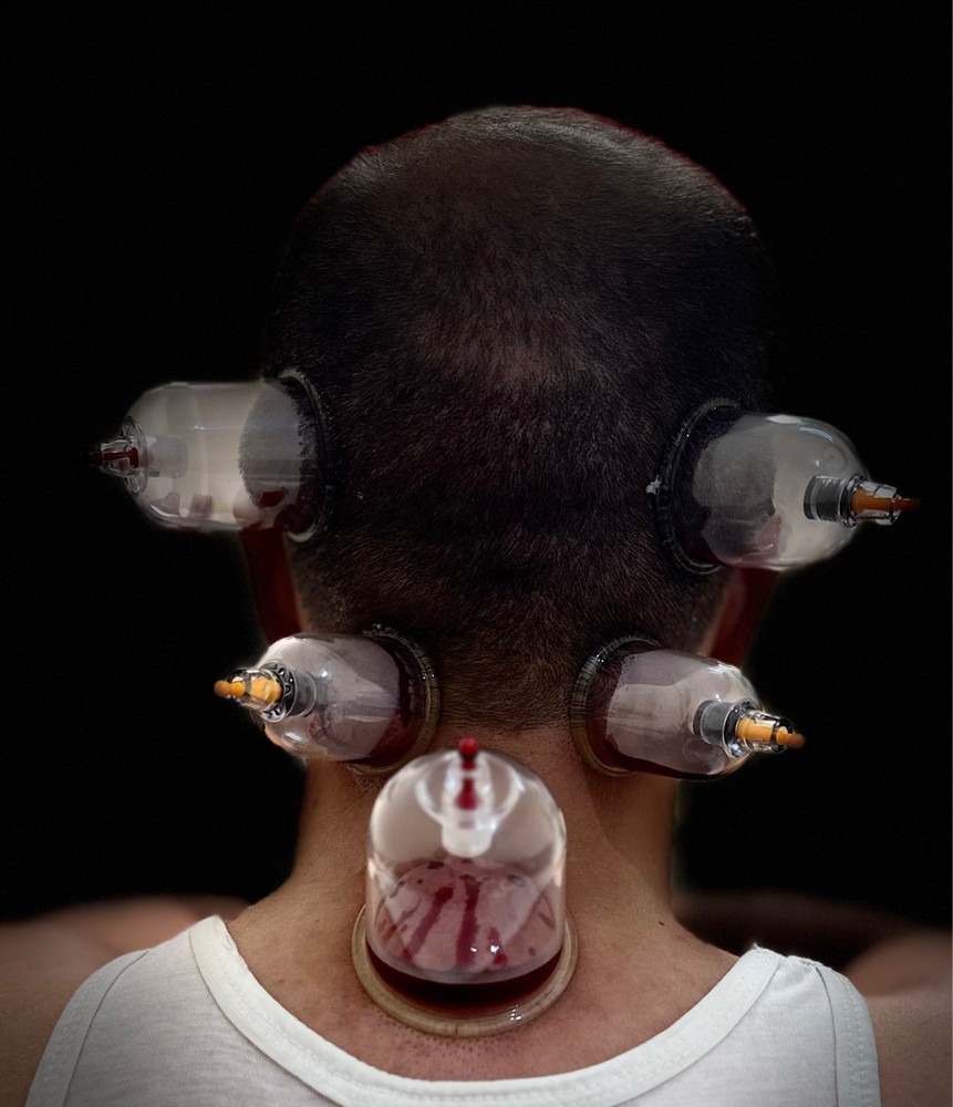 cupping therapy hijama - 10