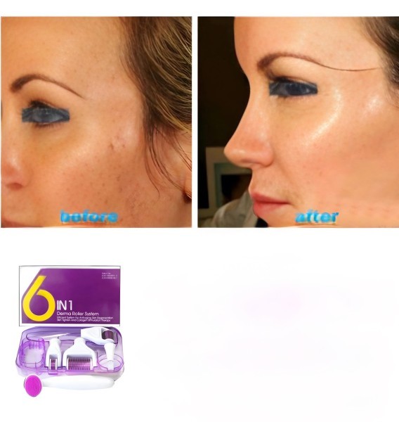 6-in-2 Derma Roller System - 4