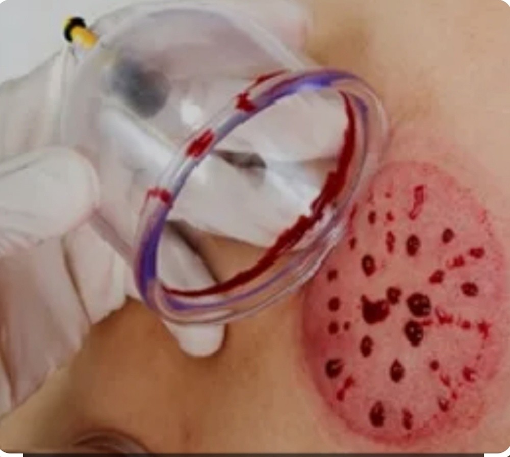Hijama. (Cupping Therophy) - 4