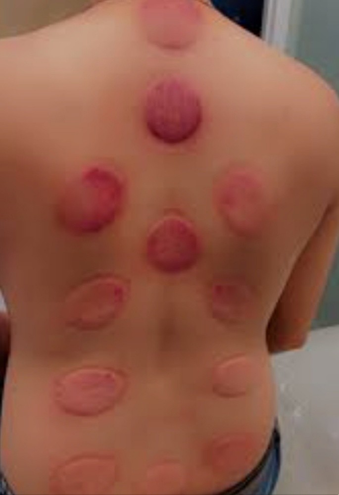 Hijama. (Cupping Therophy) - 2
