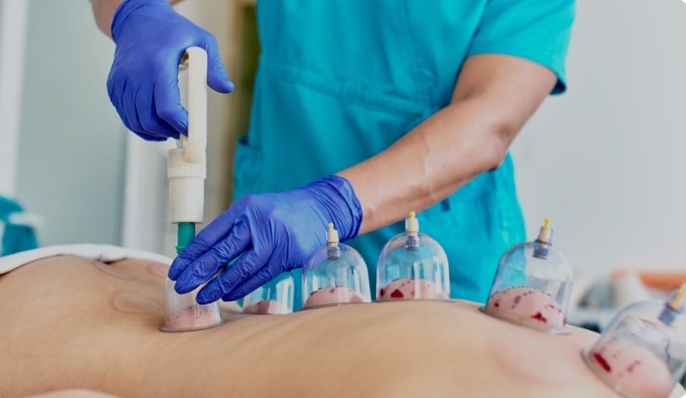 Hijama. (Cupping Therophy) - 3