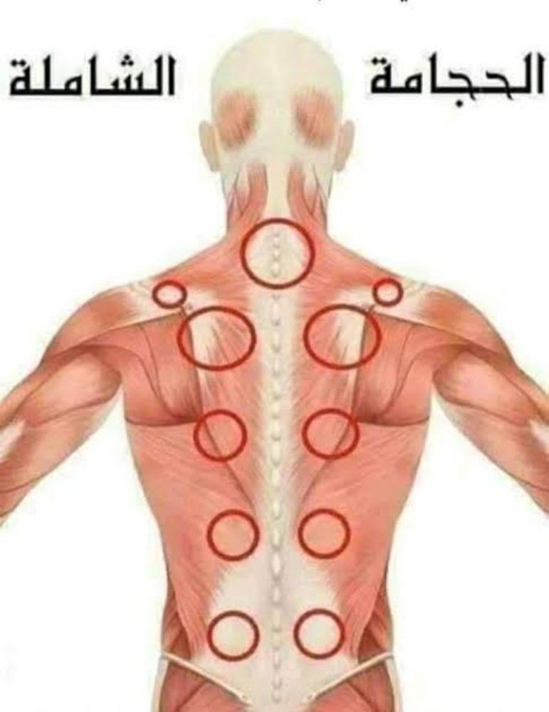 حجامة - 1