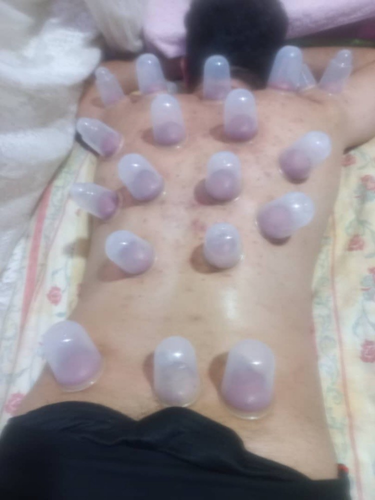 hijama - 1