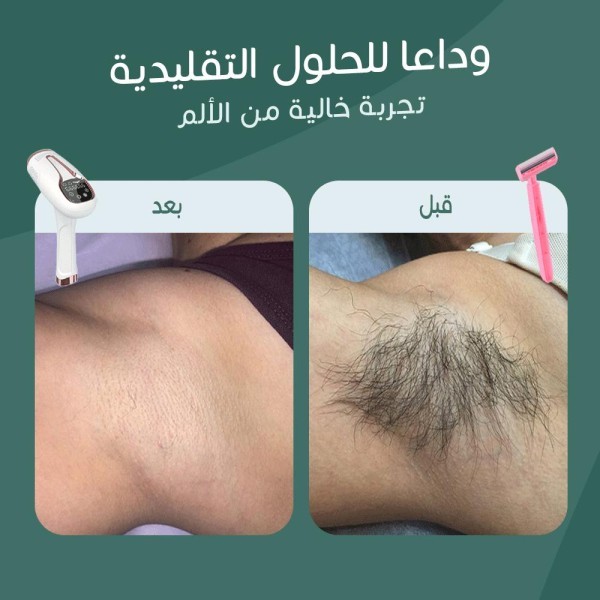 Home Laser Hair Removal Device - 7