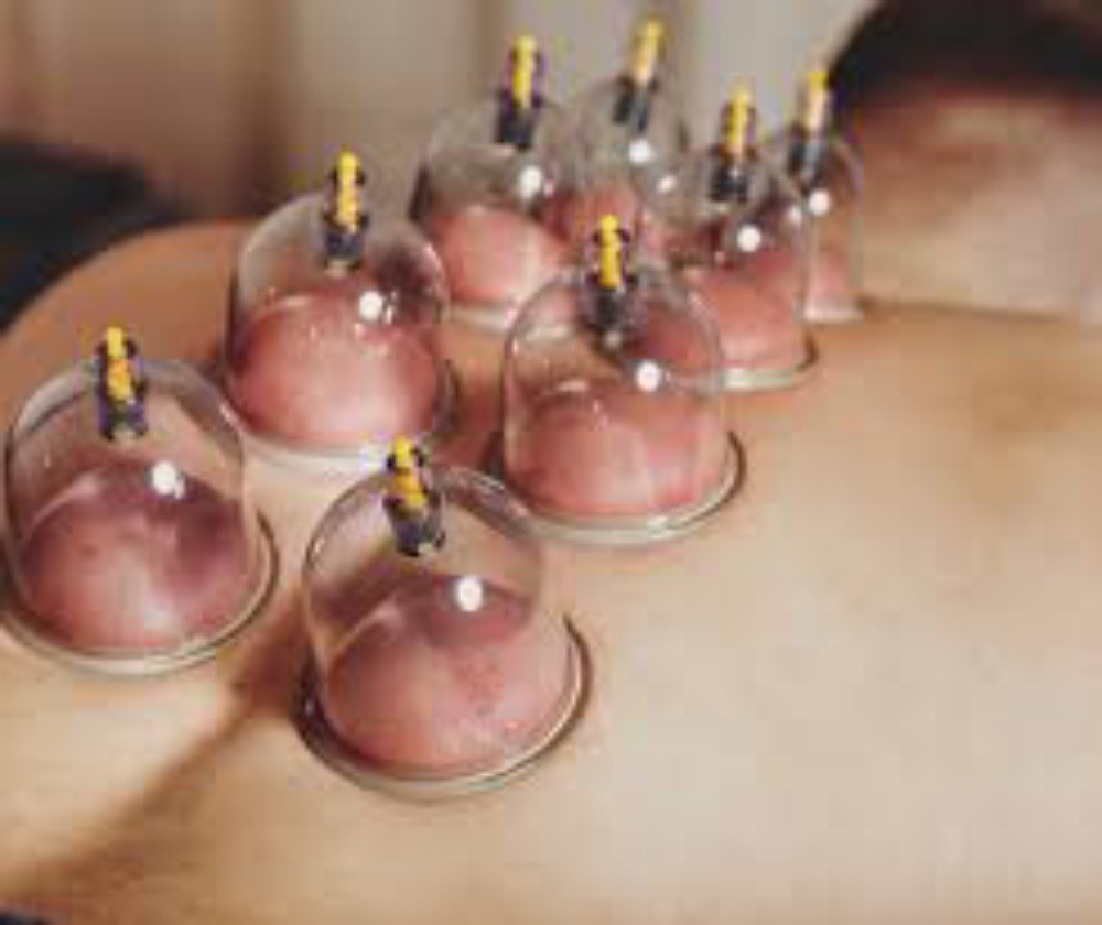 Islamic cupping - 1