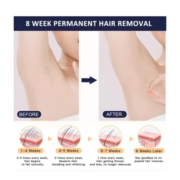 MLAY T14 Laser Hair Removal Devic - 5