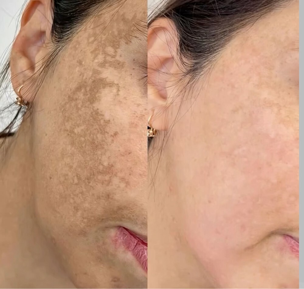melasma removal cream - 1
