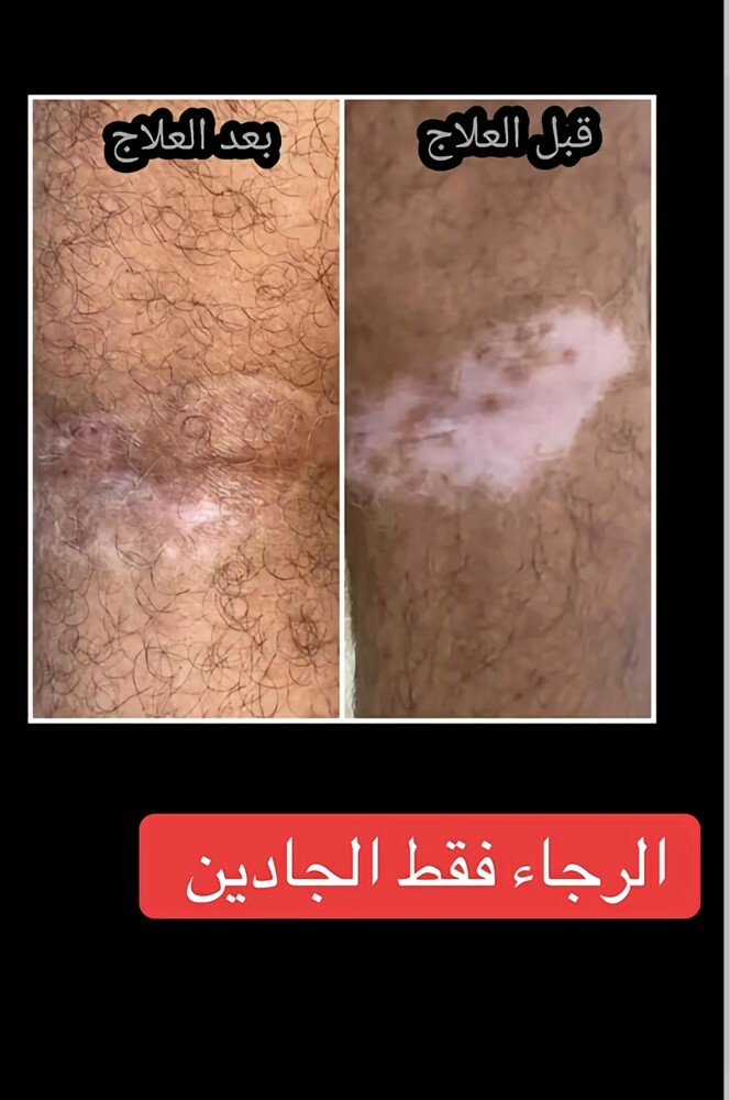 melasma removal cream - 6