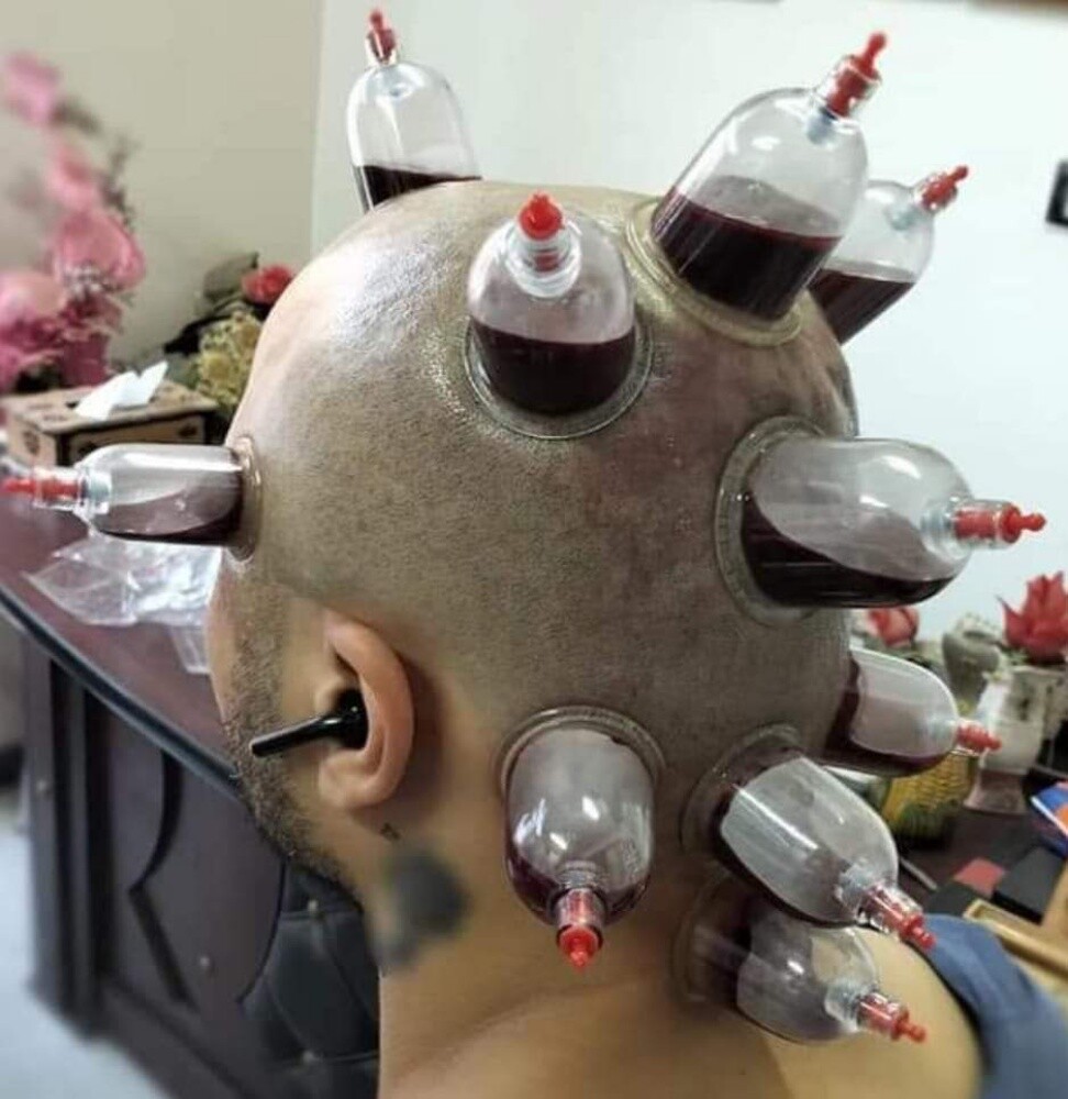 Hijama. (Cupping Therophy) - 6