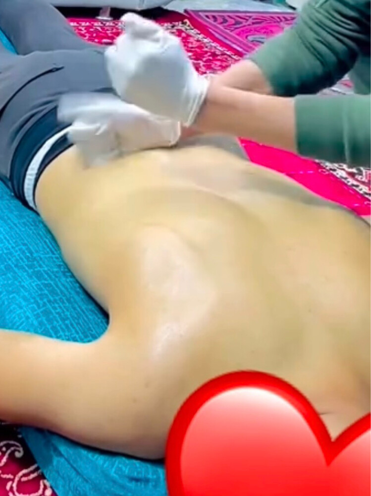حجامه جافه وتشريطيه  - 4