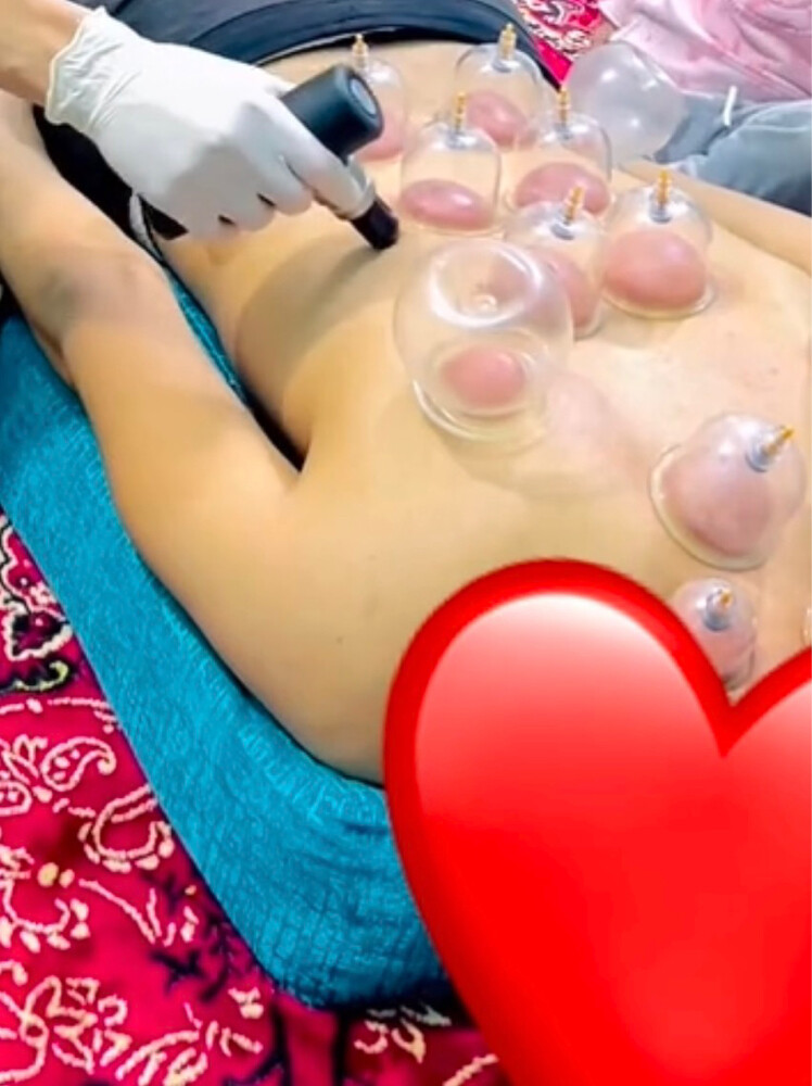 حجامه جافه وتشريطيه  - 1
