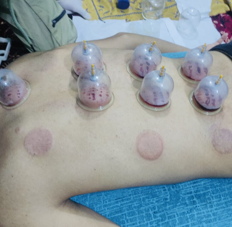 حجامه سر الشفاء وقايه من الامراض - 1
