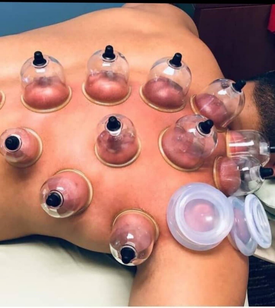 التداوي بالحجامه - 4