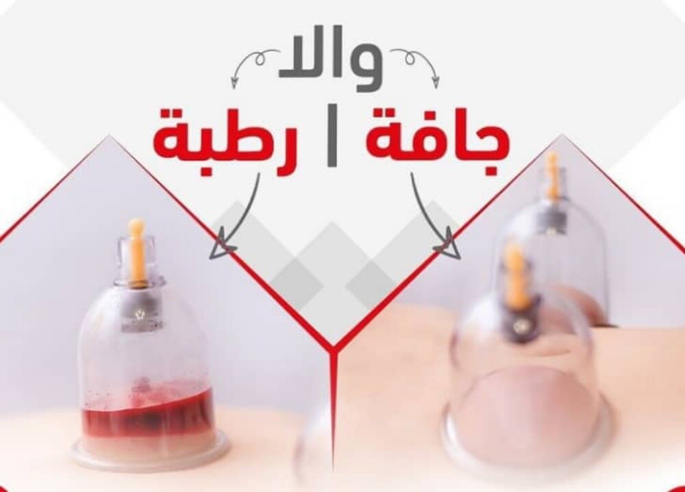 التداوي بالحجامه - 3