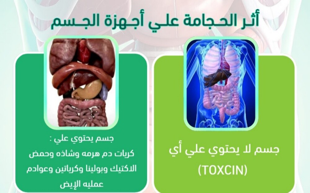 التداوي بالحجامه - 21