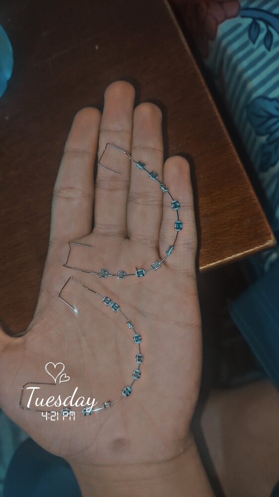 تقويم الإسنان - 2