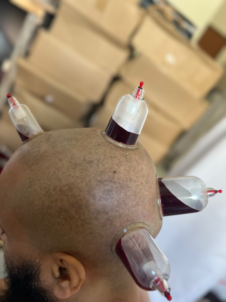 متخصص وخبير حجامه - 1