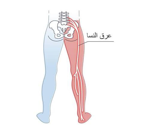 حجامه لعلاج عرق النسا - 1