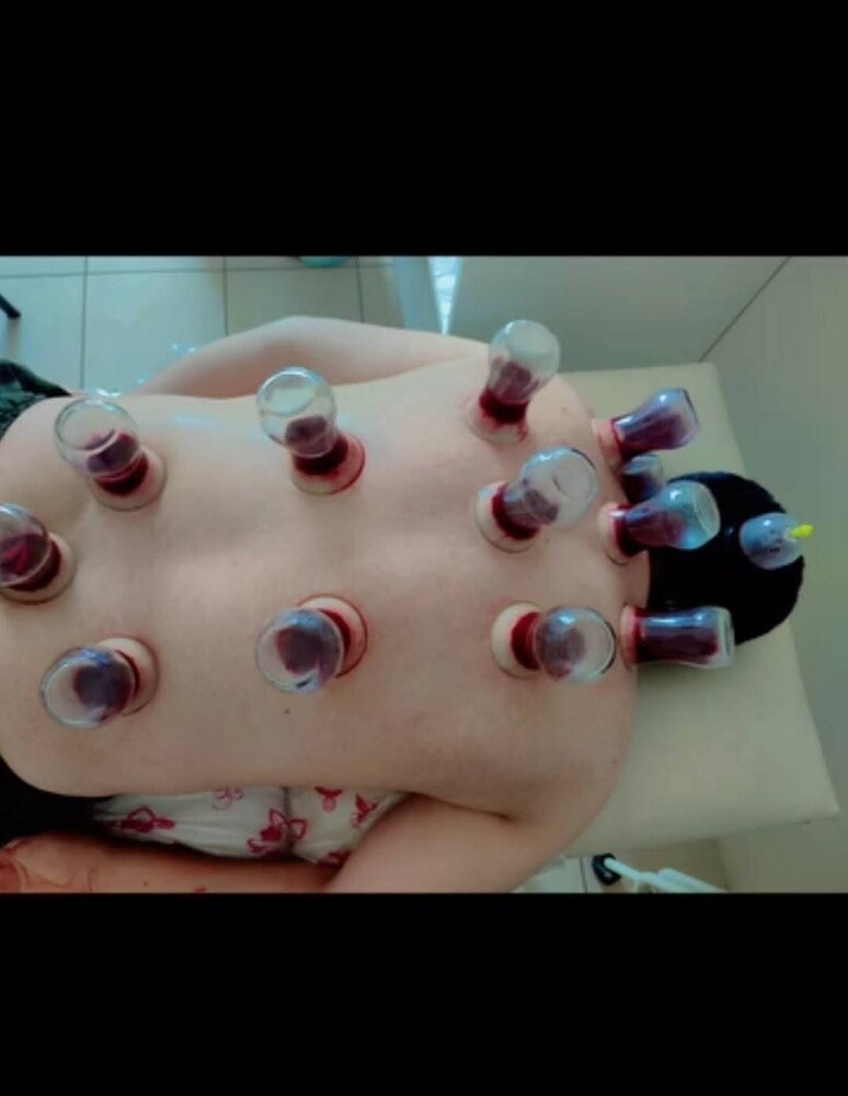 حجامه لراغبي الصحه والنشاط - 1