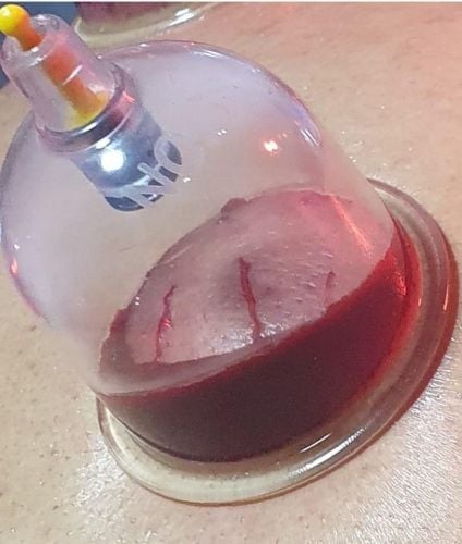 اخصائي حجامه الحجامة النبويه