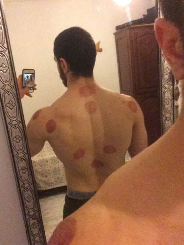 علاج طبيعي و حجامة