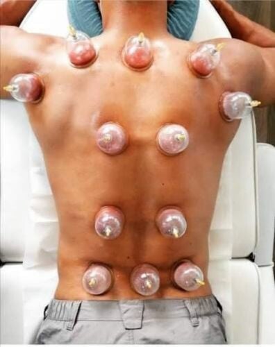 الحجامة النبوية