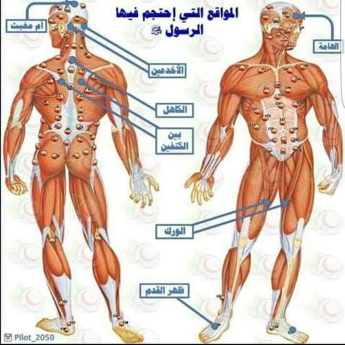   حجامه جافه وحجامه تشريطيه 