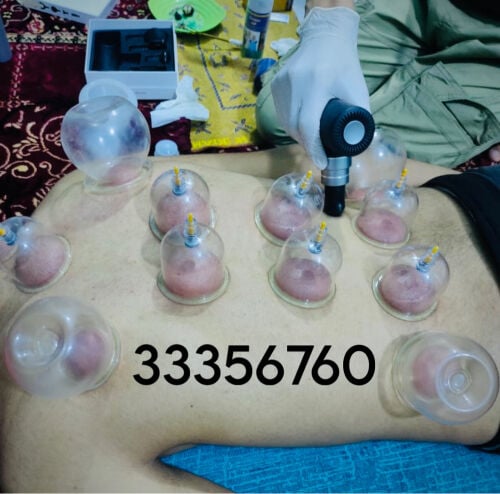 حجامه تشريطيه وجافه ومساج رياضي