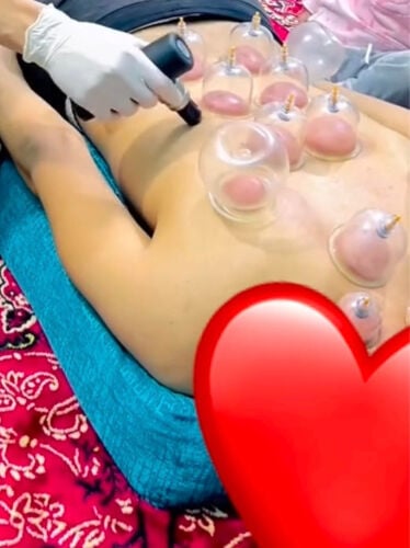 حجامه جافه وتشريطيه 