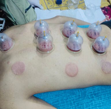 حجامه سر الشفاء وقايه من الامراض