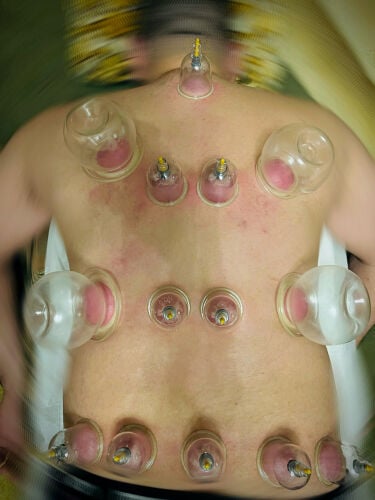 الحجامه سنة وشفاء