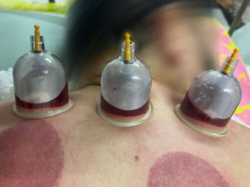 حجامه ومساج رياضي