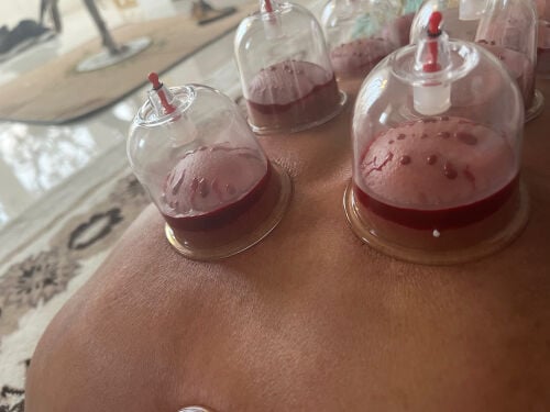 الحجامه العلاجيه والوقائية 