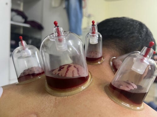 الحجامه لتاهيل الجسم من جديد